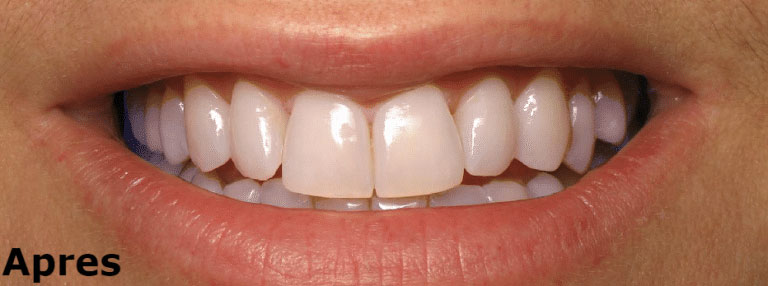 Blanchiments des dents Tunisie - Implant dentaire tunisie