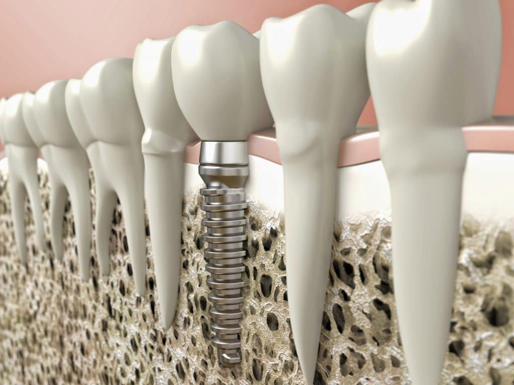 Implant dentaire - Implant dentaire tunisie