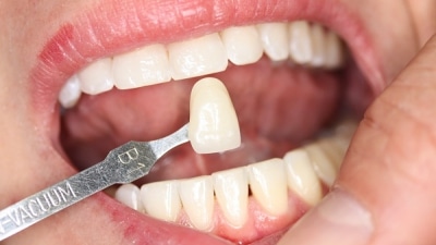 facette-dentaire