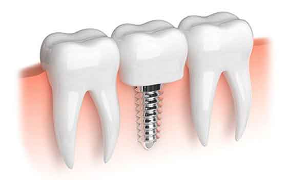 pose-implant-dentaire-tunisie