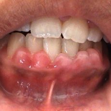Gingivectomie : les causes et techniques de la procédure Gingivectomie : les causes et techniques de la procédure