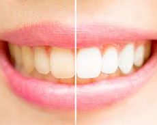Pourquoi le charbon de coquilles de noix de cocoest le meilleur pour vos dents ? Pourquoi le charbon de coquilles de noix de cocoest le meilleur pour vos dents ?