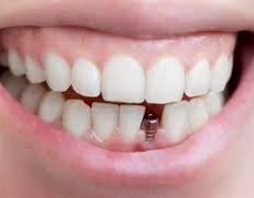 L’importance d’une planification de traitement complète avant la pose d’un implant dentaire L’importance d’une planification de traitement complète avant la pose d’un implant dentaire