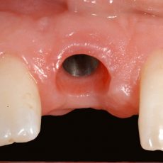 Qu’est-ce qu’un implant ? Qu’est-ce qu’un implant ?