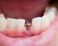 L’importance d’une dentition complète L’importance d’une dentition complète
