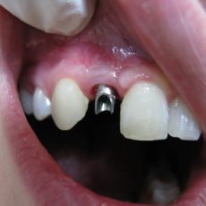 Quelle différence entre l’implant dentaire et le bridge ? Quelle différence entre l’implant dentaire et le bridge ?