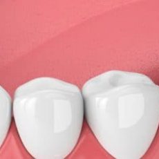 Les avantages des implants dentaires Les avantages des implants dentaires