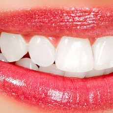 Blanchiment des dents: quels types de traitements existent? Blanchiment des dents: quels types de traitements existent?
