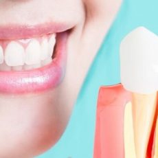 Quels sont les implants à chargement immédiat ? Quels sont les implants à chargement immédiat ?
