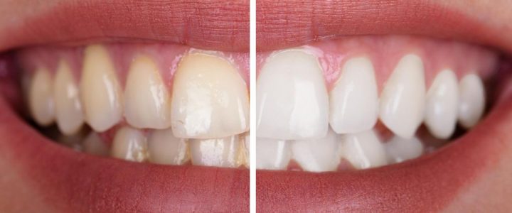 Blanchiment des dents : tout ce que vous devez savoir blanchiment-dentaire-notre-selection
