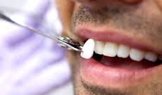 Facette veneers Tunisie Facette veneers Tunisie