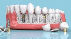 Implant dentaire en Turquie Implant dentaire en Turquie