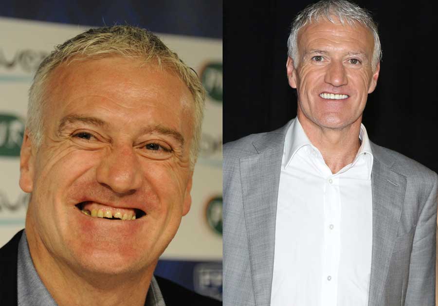 Didier-Deschamps facettes dentaires