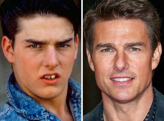 Chirurgie dentaire de Tom Cruise