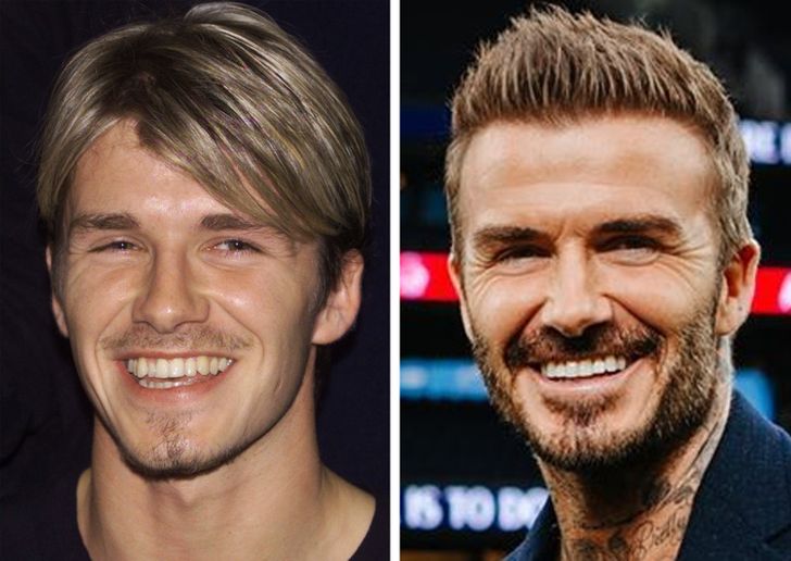 David Beckham et la chirurgie dentaire