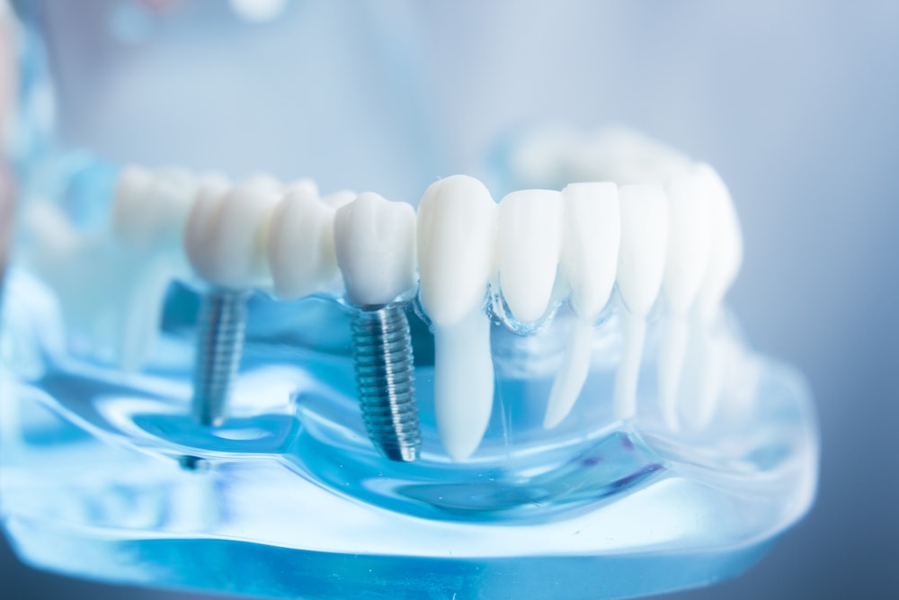alternatives pour remplacer les implants dentaires