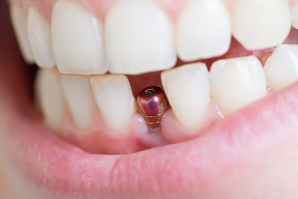 Mieux savoir sur l’Implant dentaire